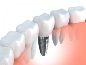 Dental implant
